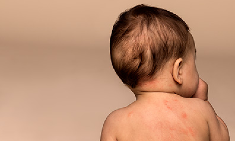 Baby Eczema Looks Different On Every Skin Tone