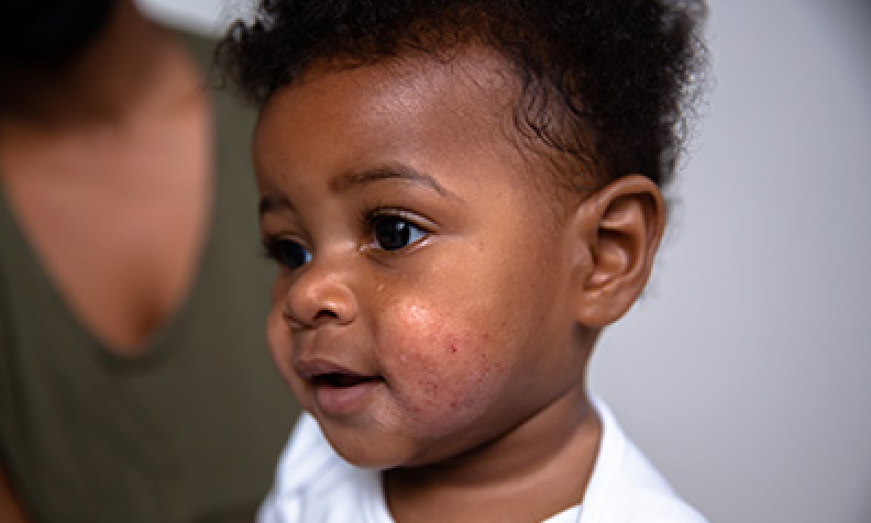 Eczema Face African American